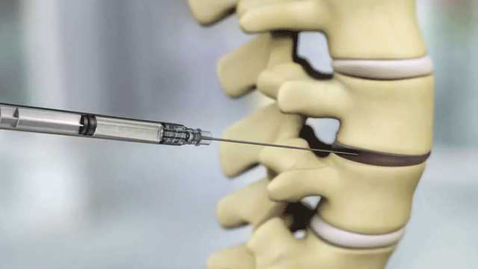 Exosomes stem cells  injectable-discogenic-cell-therapy
