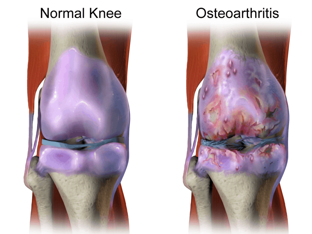 Exosomes stem cells Osteoarthritis-1024x768